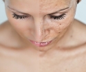 Cum să vă curățați fața de pe petele de pigmentare