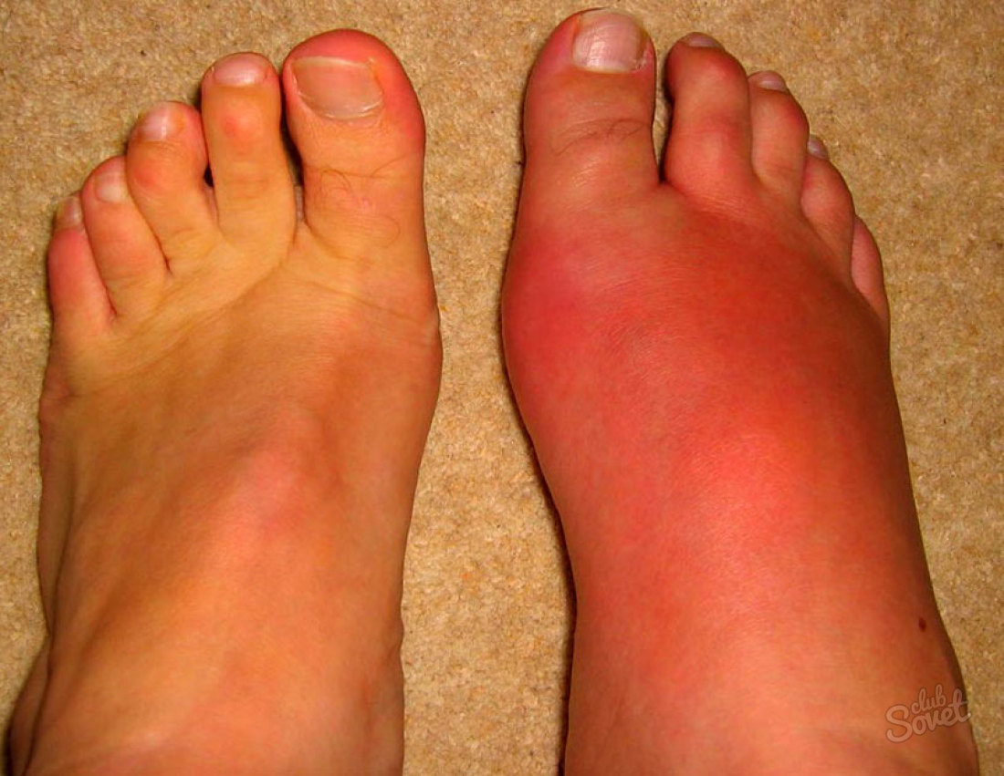 Elendy Fußentzündung - Symptome und Behandlung