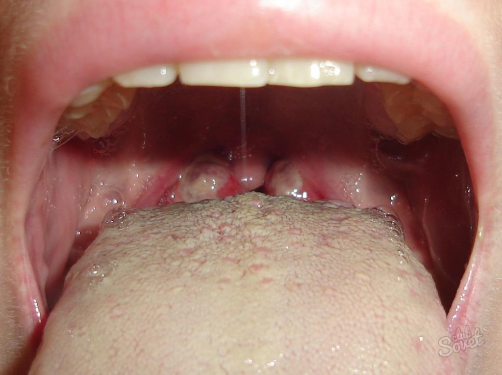 Eruzione cutanea in gola come trattare