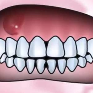 Kako za zdravljenje fistulo na dlesni