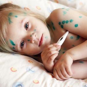 How chickenpox begins in children
