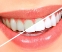 Wie man die Zähne von Wasserstoffperoxid aufhellt