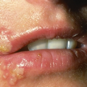 Photo What does herpes look like