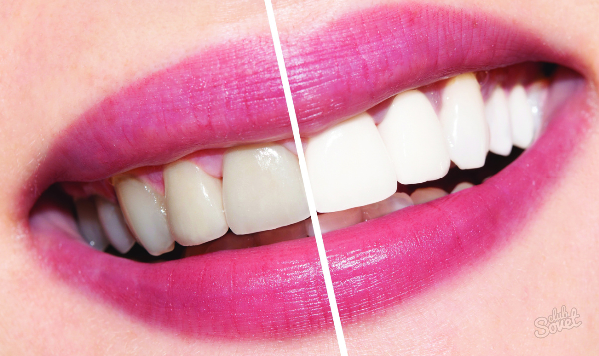 როგორ უნდა whiten თქვენი კბილები დღეში