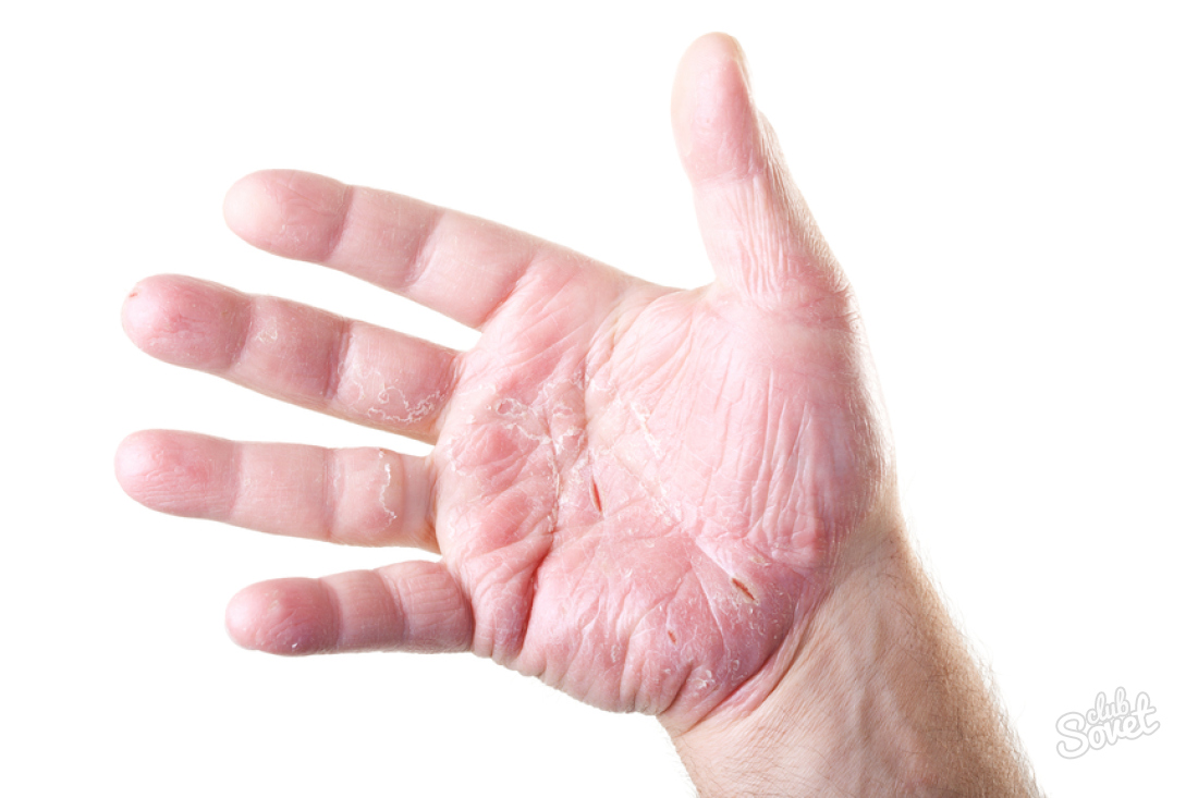 Comment guérir ancase sur les mains