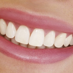 How to remove the gap between the teeth