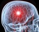 Príčiny a prevencia mŕtvice mozgu