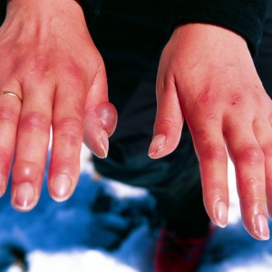 Fotografija kako liječiti opekline kože