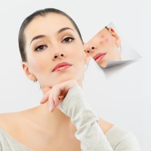 Kako se riješiti acne za 1 dan