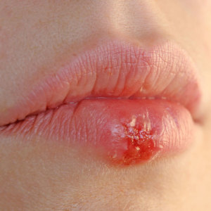 Wie kann man eine Erkältung auf der Lippe heilen?