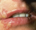 What herpes looks like