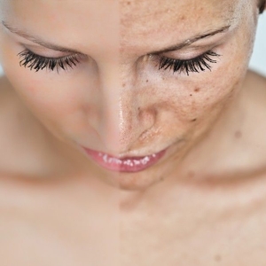 Фото как очистить лицо от пигментных пятен