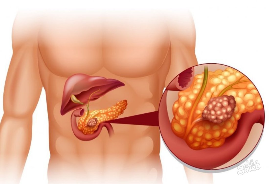 I segni di infiammazione del pancreas
