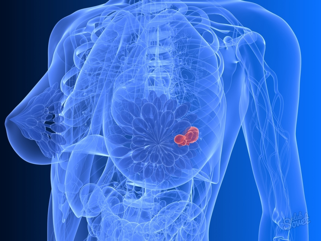 Как определить рак молочной железы