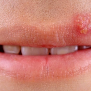 How to treat cold on the lips