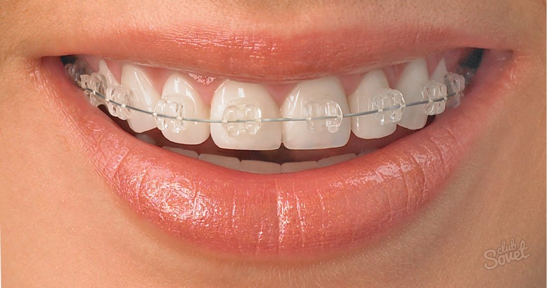 როგორ ფუნჯი კბილები braces