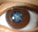 O que é glaucoma