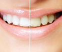 Gel sbiancante per i denti - Vero o mito
