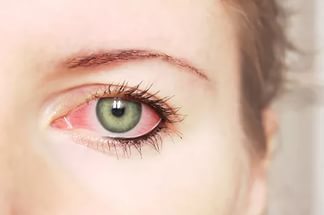 Красные глаза, причины и лечение