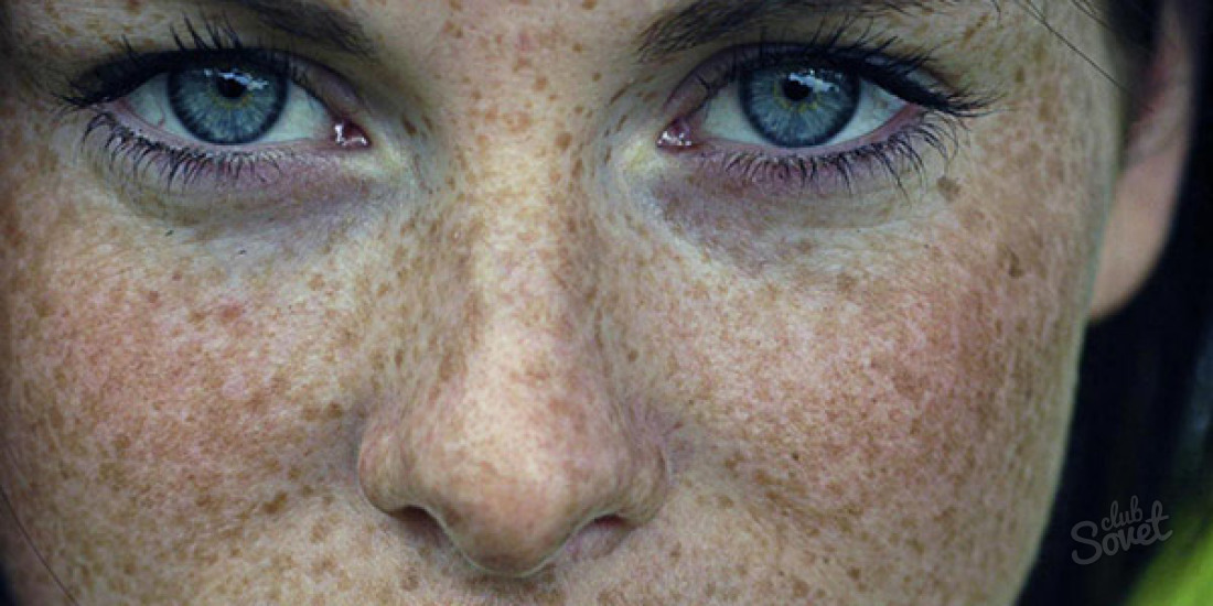 Пигментные пятна на лице – причины и лечение