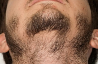 Kako rastejo brado, če ne raste