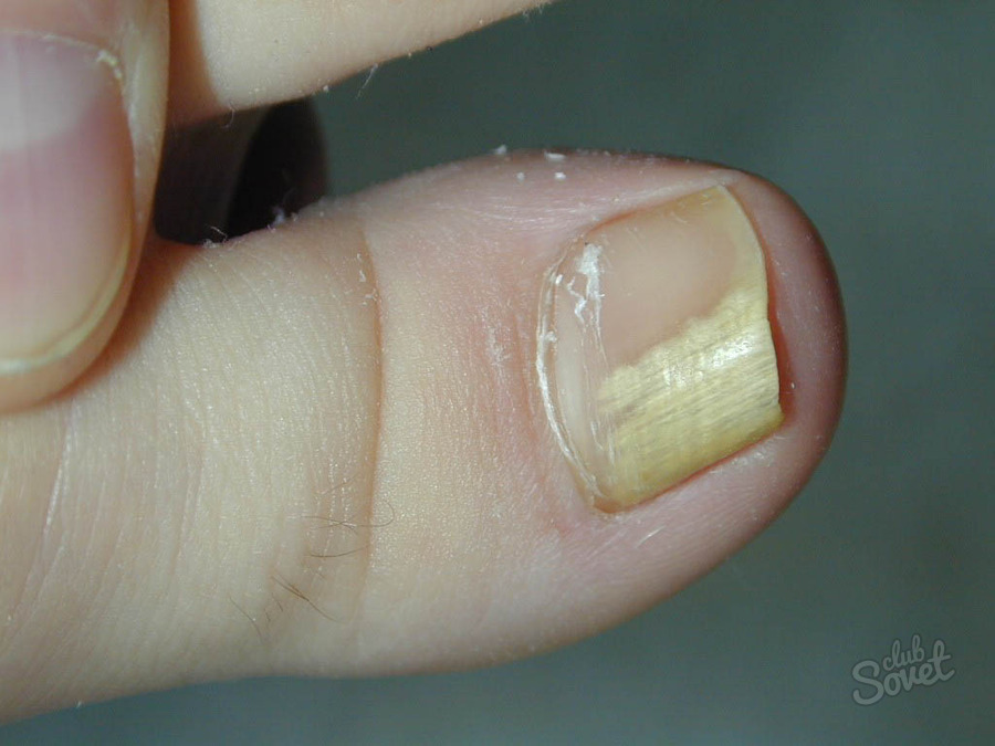 How to cure nail fungus on legs