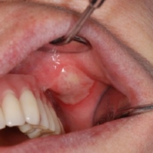 Jak pozbyć się zapalenia jamy ustnej