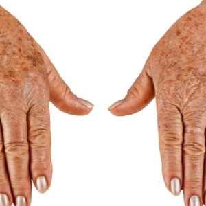 Foto Como remover manchas nas mãos
