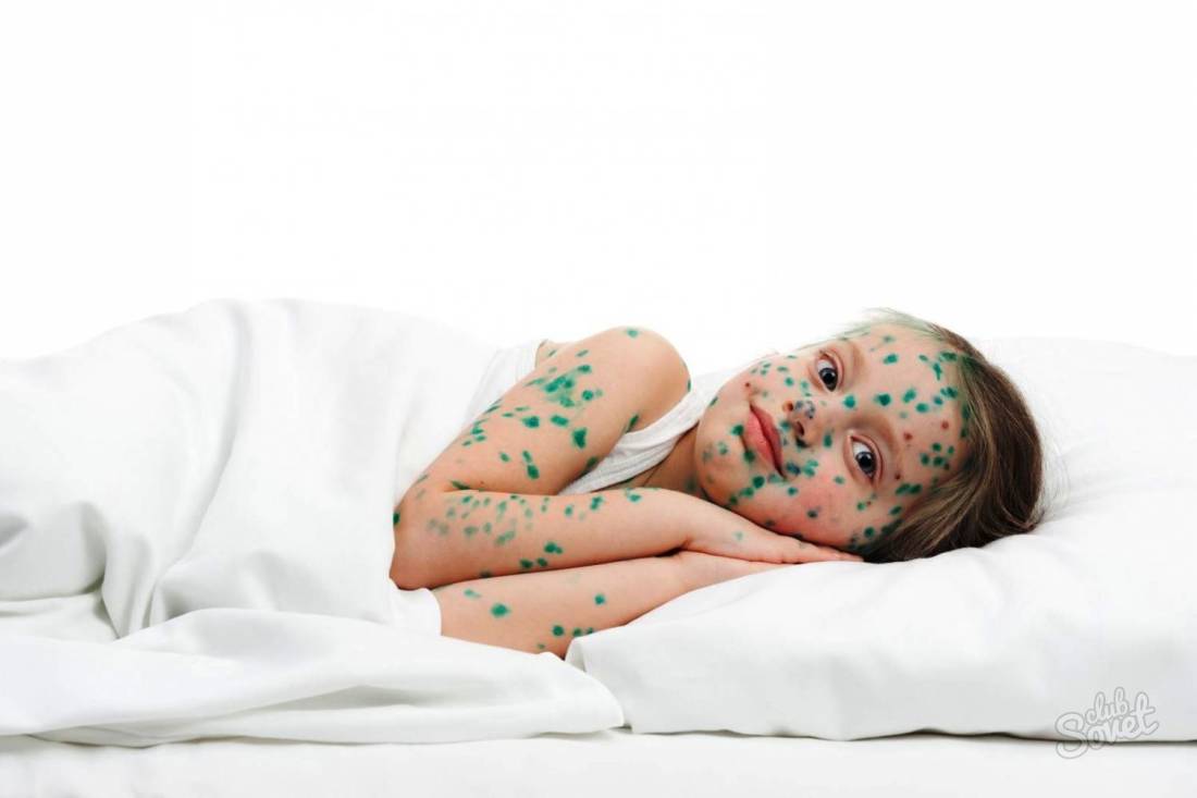 Como tratar a varicela em crianças
