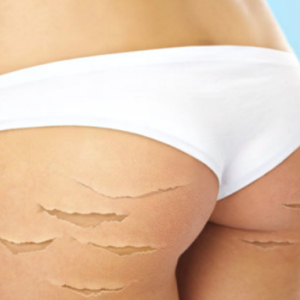 How to remove stretch marks on the legs