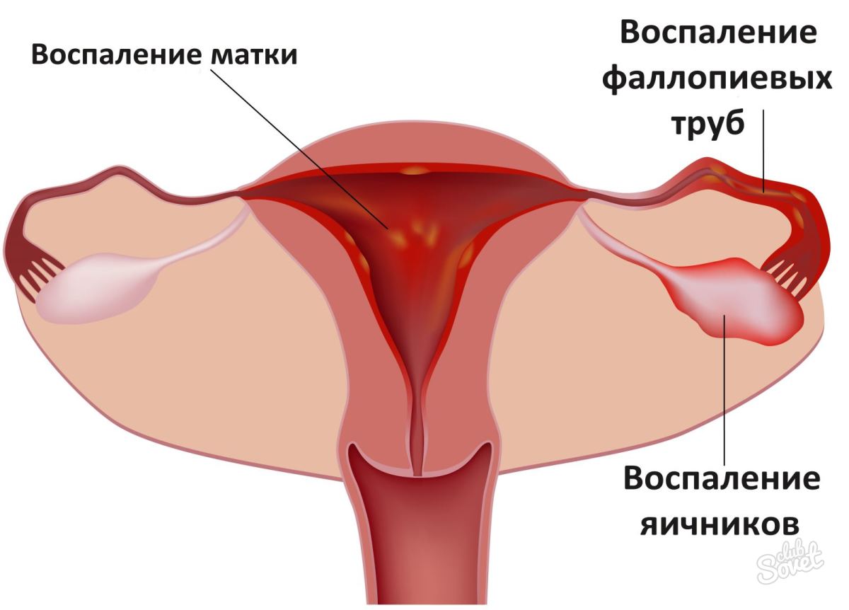 Infiammazione dell'utero dell'ovaio
