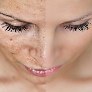 How to get rid of pigment spots on the body