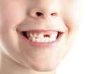 Fiel auf den Zahn in einem Kind, was zu tun ist