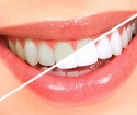 چگونه به سفید کردن دندان های خود را در خانه