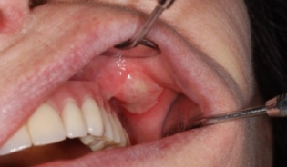 Hogyan lehet megszabadulni a szájgyulladéktól