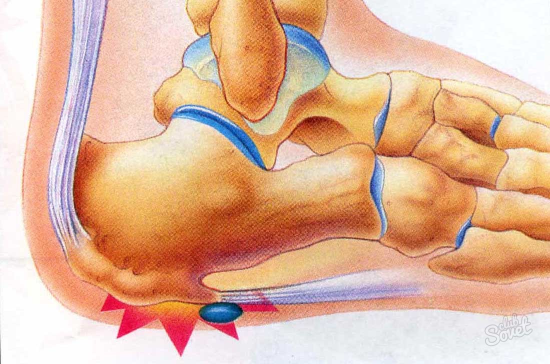 การรักษาอาการปวดส้นเท้าของผู้คน