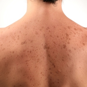 Stock Foto Spots from acne on the back, how to get rid of