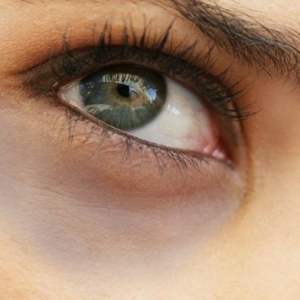 How to get rid of dark circles under the eyes