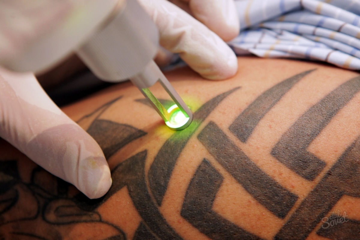 Come ridurre il tatuaggio