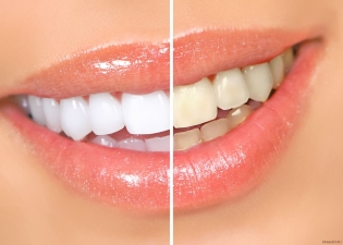 چه روش های خانگی دندان ها را سفید نمی کنند