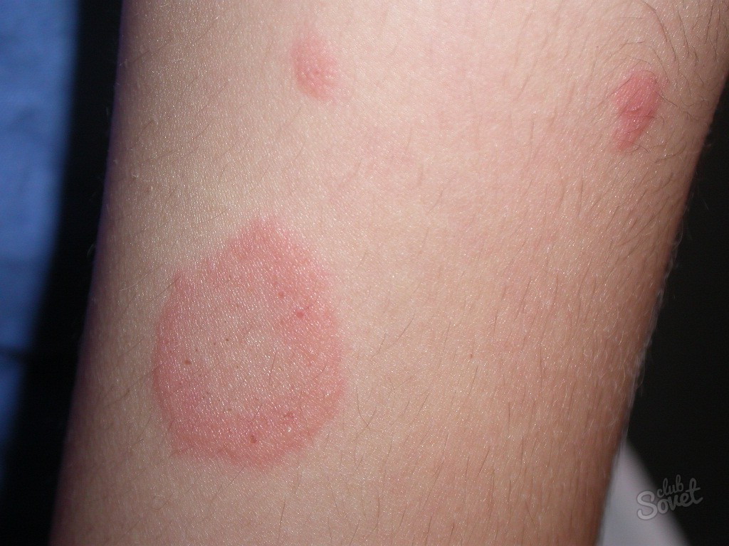 Come sbarazzarsi dell'eczema