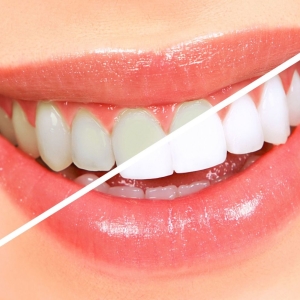 როგორ უნდა whiten თქვენი კბილები სახლში
