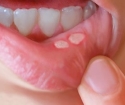 Ako liečiť vredy v ústach