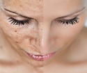 How to get rid of pigment spots on the body