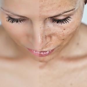 Foto Como se livrar de pontos depois da acne