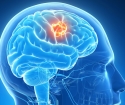O que é um acidente vascular cerebral?