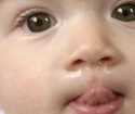 Guma u niemowląt - jak leczyć