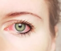 Красные глаза, причины и лечение