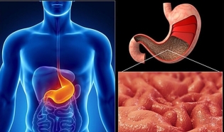 What is gastritis