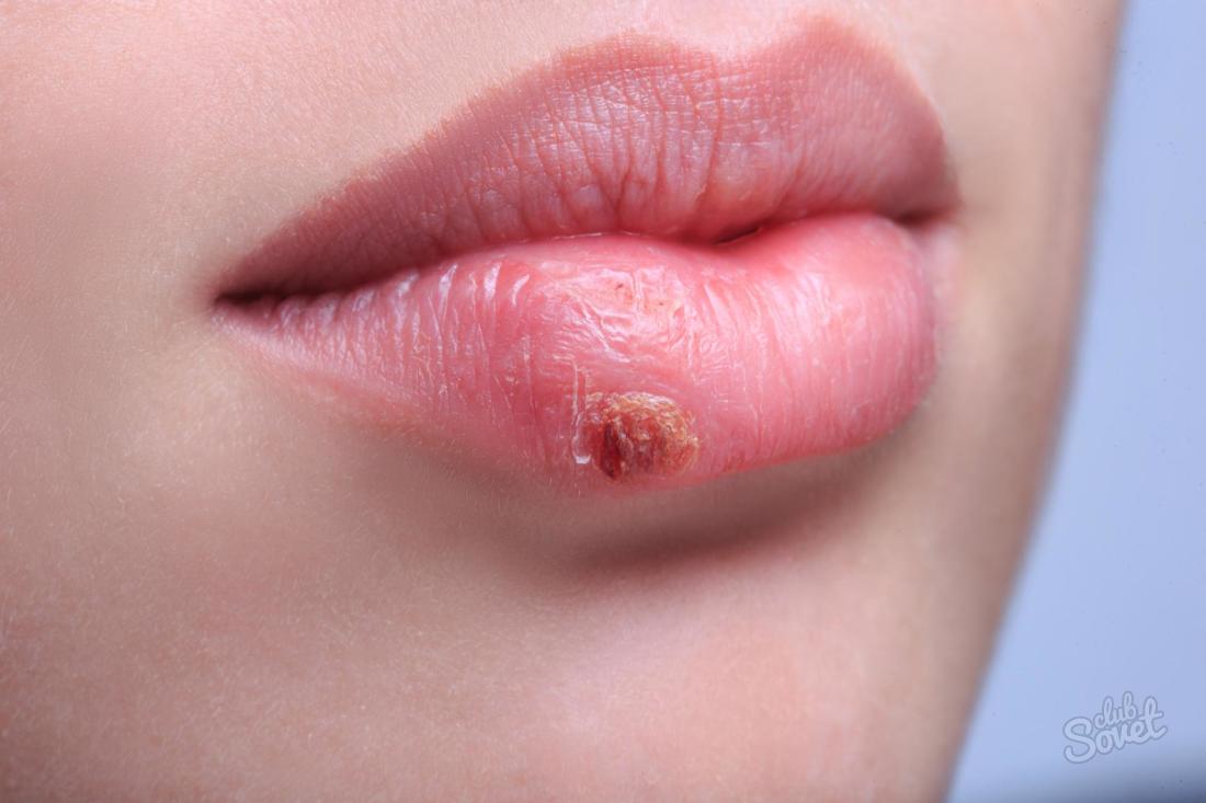 Kako brzo izliječiti herpes na usnama
